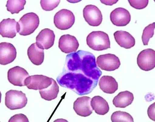 причины лимфомы Беркитта