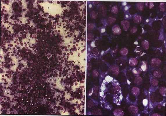 Лимфомы из зрелых В-клеток