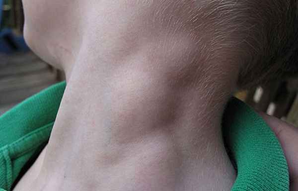 Стадии лимфомы Ходжкина