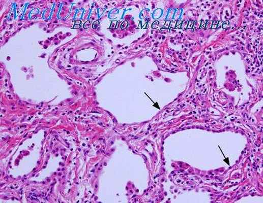 аллергический гранулематоз