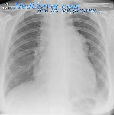 лимфосаркомы