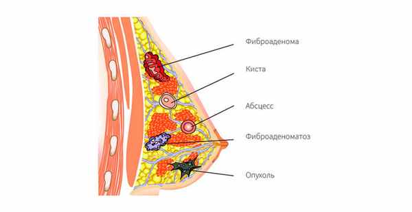 Фиброаденома фото
