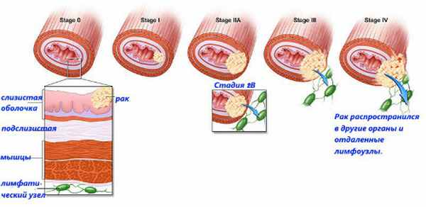 стадии опухоли пищевода