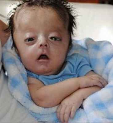 синдром Уокера-Варбурга