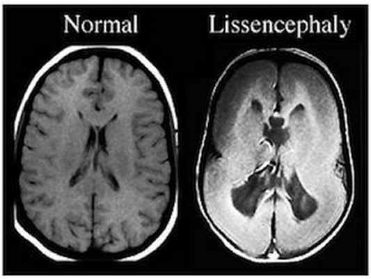 мальформация и нормальный мозг