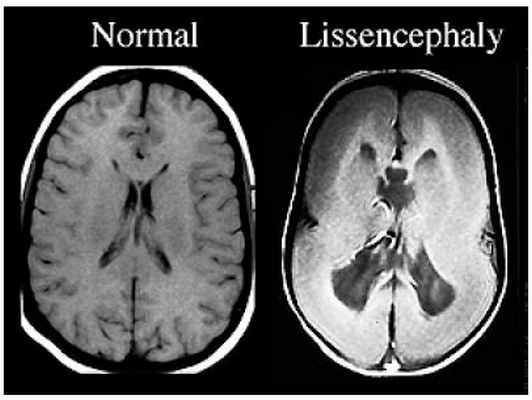 Лиссэнцефалия 