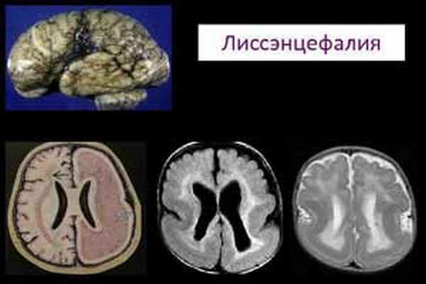 лиссэнцефалия