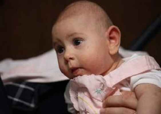 Микроцефалия