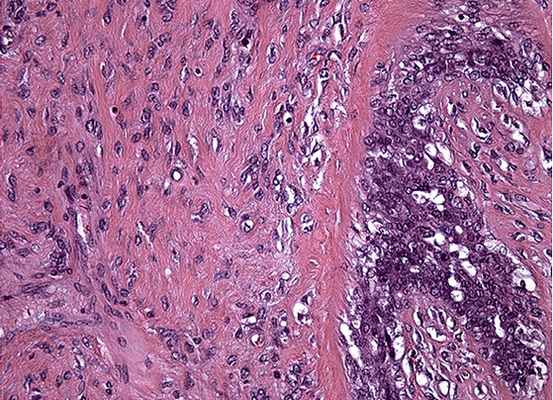 Пролиферация эпителия и клеточных элементов стромы. Окраска гематоксилин-эозином, увеличение 20х10