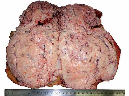 Препарат удаленной опухоли