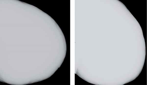 Маммография больной В., 45 лет. Описание в тексте