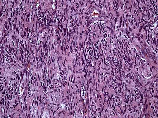 Листовидная опухоль пограничного типа. Выраженная пролиферация клеточных элементов стромы, митозы отсутствуют. Окраска гематоксилин-эозином, увеличение 20х10