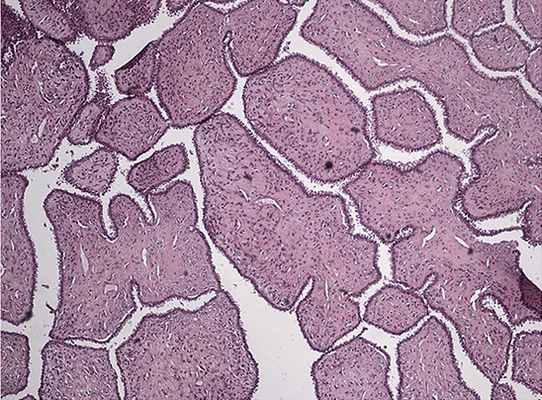 Листовидная опухоль. Окраска гематоксилин-эозин, увеличение 5х10