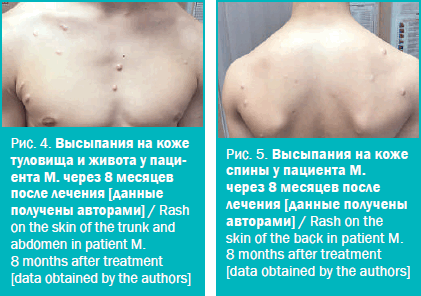 Высыпания на коже туловища и живота у паци- ента М. через 8 месяцев после лечения