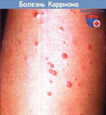 Болезнь Карриона (перуанская бородавка)