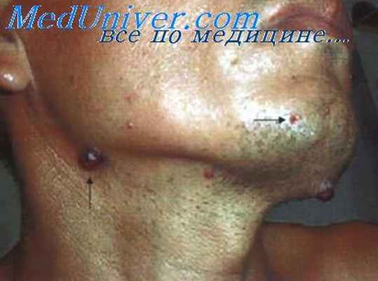 бартонеллез