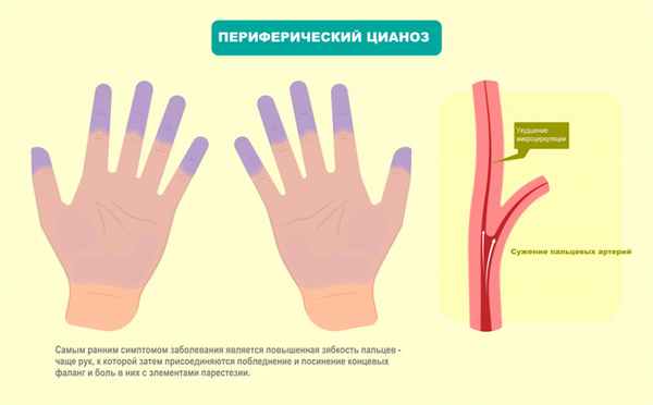 Синдром Рейно.jpg