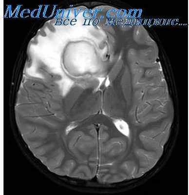 отогенный абсцесс