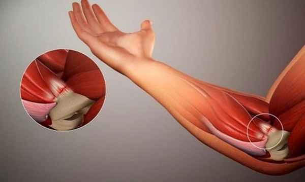 Туннельный синдром локтевого канала: симптомы, диагностика, лечение