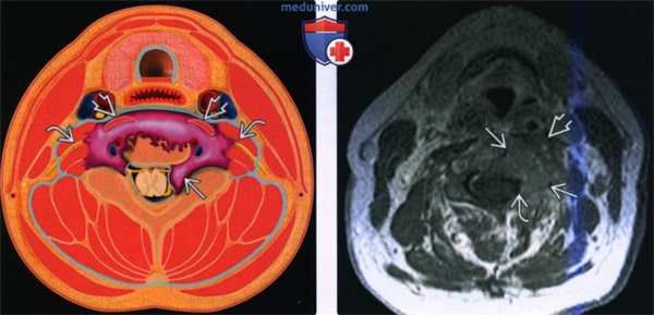 Введение в лучевую диагностику паравертебрального пространства: лучевая анатомия, методы исследования