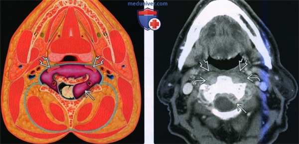 Введение в лучевую диагностику паравертебрального пространства: лучевая анатомия, методы исследования