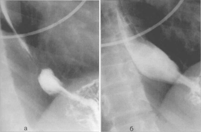 Рентгенограммы пищевода на уровне диафрагмального отверстия.