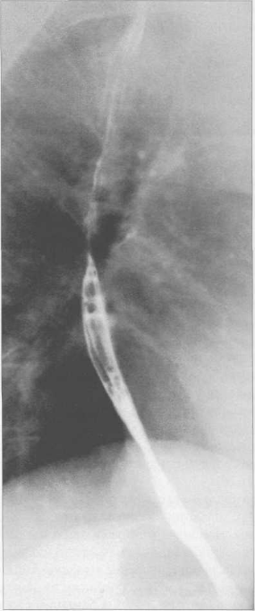 Рентгенограмма пищевода в боковой проекции.