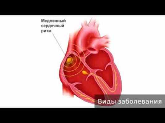 Брадикардия. Как лечить брадикардию.