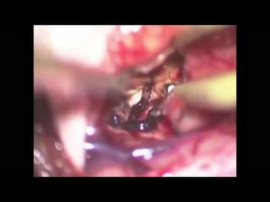 Операция. Удаление каверномы головного мозга.