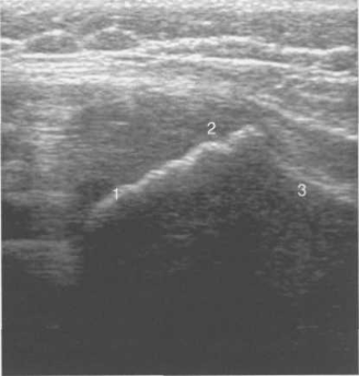 Область хрящевого большого вертела (11 мес).