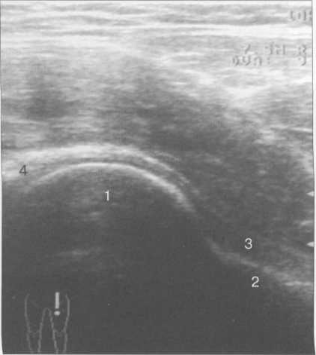 УЗИ тазобедренных суставов взрослого