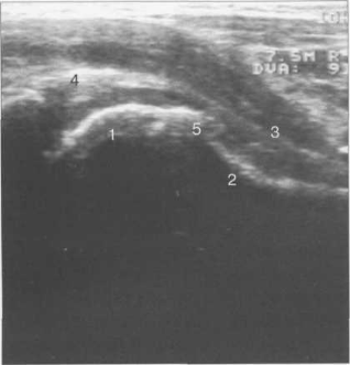 УЗИ тазобедренного сустава по передней поверхности вдоль шейки бедра (8 лет).