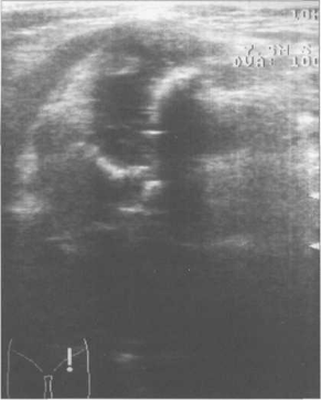 УЗИ тазобедренных суставов в положении сгибания в аксиальной плоскости, получение «U» схемы.