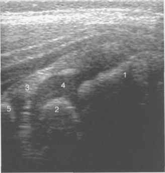Боковой доступ, продольное сканирование тазобедренного сустава (2 года).