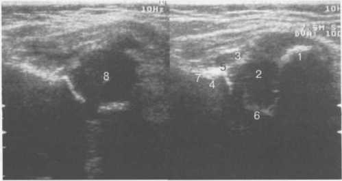 УЗИ тазобедренных суставов (1 мес).