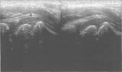 УЗИ тазобедренного сустава (2 года). Продольное сканирование передним доступом.