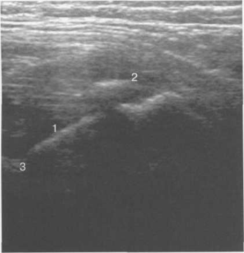 Боковой доступ, сканирование продольно вдоль шейки бедра (7 лет).