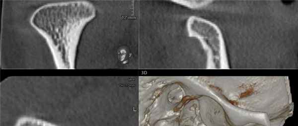 КТ ВНЧС закрытое положение