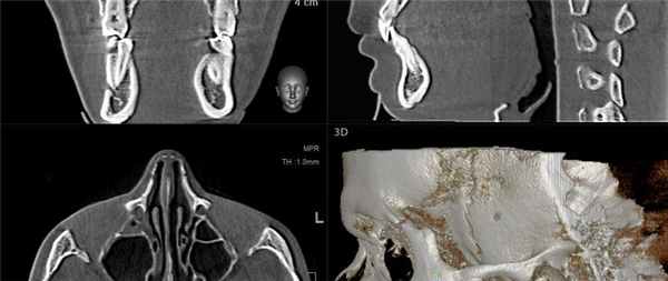 Две челюсти + ВНЧС