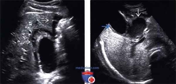 УЗИ, КТ при остром калькулезном холецистите