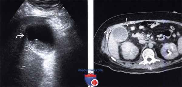 УЗИ, КТ при остром калькулезном холецистите