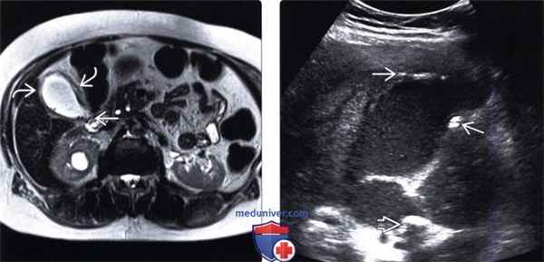 УЗИ, КТ при остром калькулезном холецистите