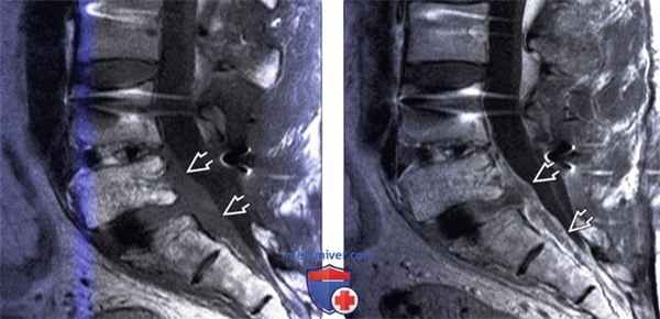 КТ, МРТ бруцеллезного спондилита