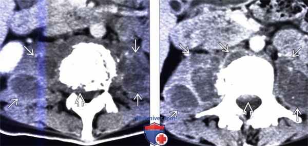 КТ, МРТ бруцеллезного спондилита