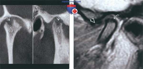 Лучевая диагностика дегенеративного заболевания височно-нижнечелюстного сустава (ВНЧС)