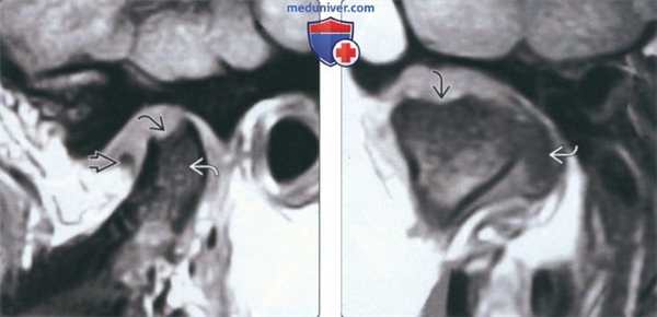 Лучевая диагностика дегенеративного заболевания височно-нижнечелюстного сустава (ВНЧС)