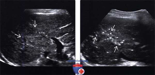УЗИ печени при диффузных микроабсцессах