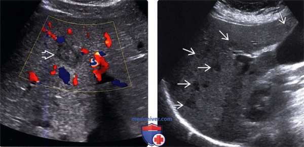 УЗИ печени при диффузных микроабсцессах