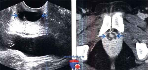КТ, МРТ, цистоуретрография при дивертикуле уретры