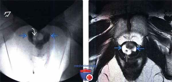 КТ, МРТ, цистоуретрография при дивертикуле уретры